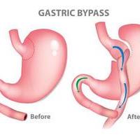 Gastric Bypass Surgery Dubai